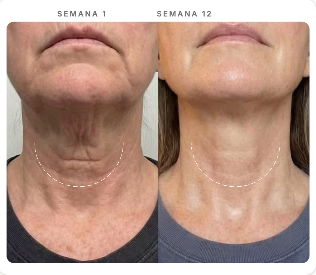 Comparação Semana 1 e Semana 12 — Firmeza Facial & Densidade Dérmica
