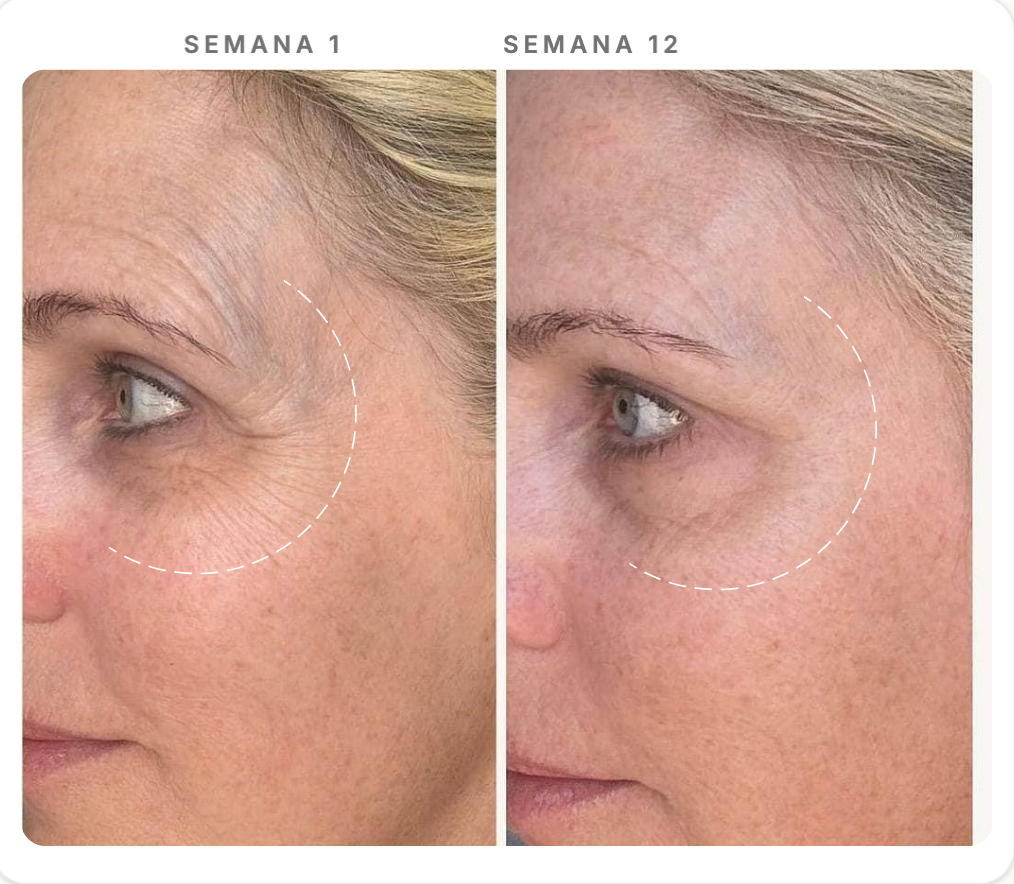 Comparação Semana 1 e Semana 12 — Contorno dos Olhos