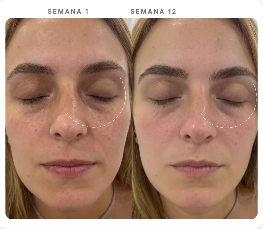 Comparação Semana 1 e Semana 12 — Olheiras & Área Periocular