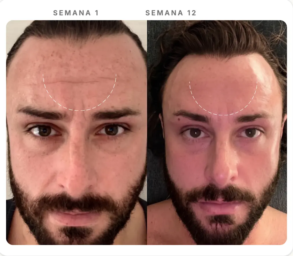 Comparação Semana 1 e Semana 12 — Linhas da Testa