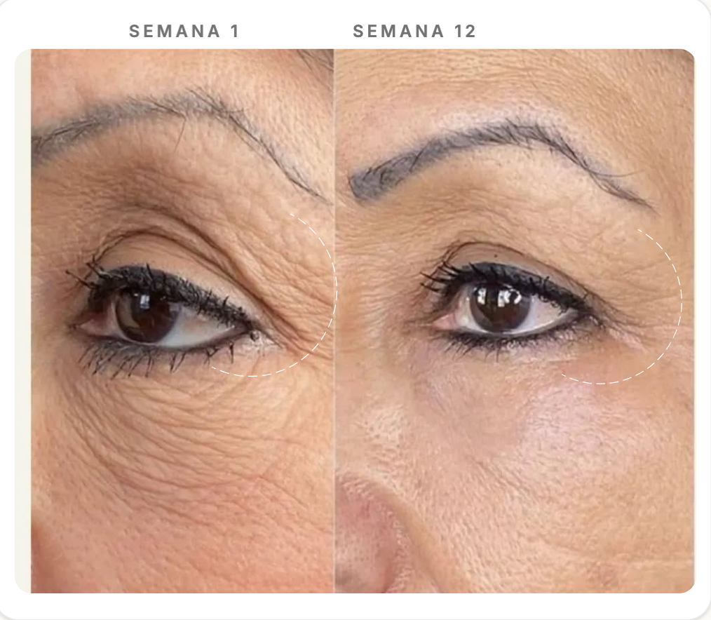 Comparação Semana 1 e Semana 12 — Rejuvenescimento Global & Luminosidade